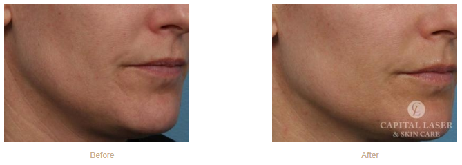 Halo Laser Before and After