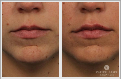 Juvederm Before and After