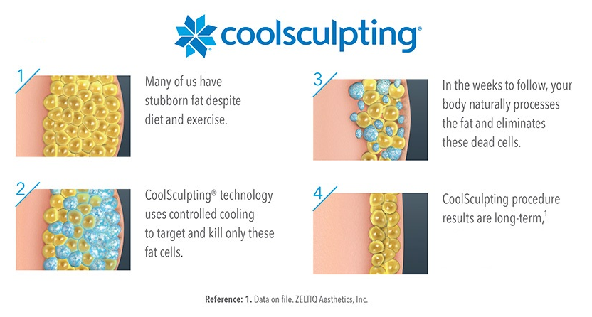 coolsculpting how it works Washington DC