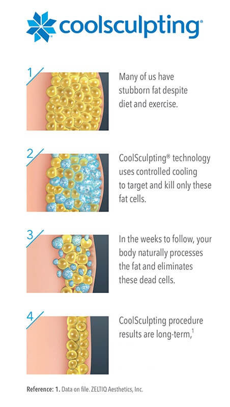 How Coolsculpting Works Tanzi
