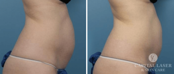 Coolsculpting Treatment Chevy Chase