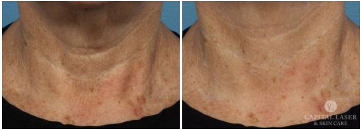 RF Microneedling, Chevy Chase