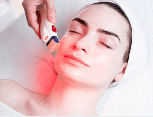 Radiofrequency Microneedling for Acne Scars