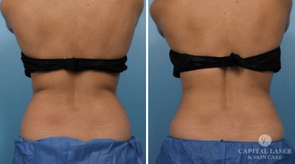 CoolSculpting Treatment Chevy Chase