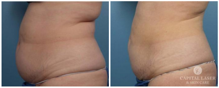 Coolsculpting Chevy Chase