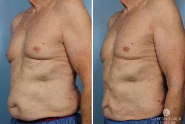 CoolSculpting Chevy Chase
