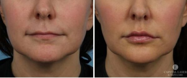 Dermal Fillers Chevy Chase