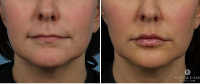 Chevy Chase Dermal Fillers