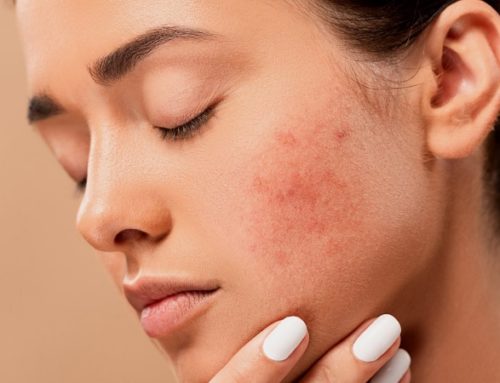 Top 3 Advanced Acne Treatments Available for Breakouts & Scarring
