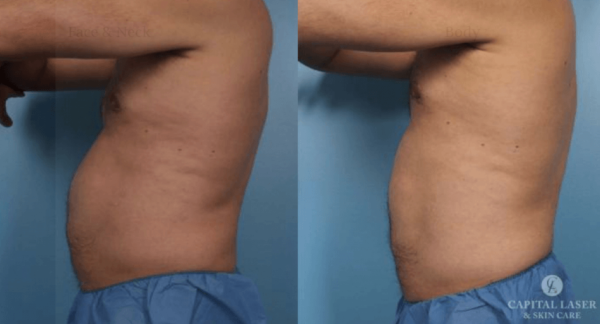 Coolsculpting Chevy Chase