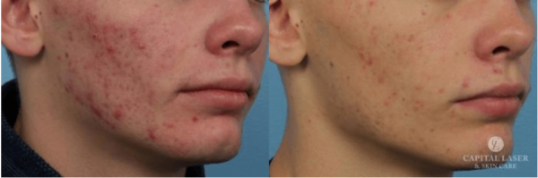 Acne Treatment Chevy Chase