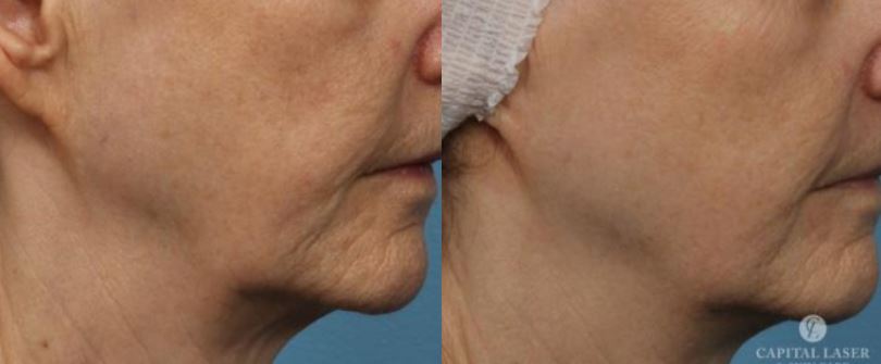Chevy Chase Rf Microneedling