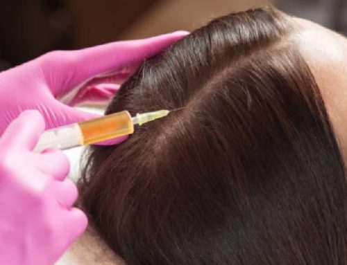 How Does PRP Reverse Hair Loss?