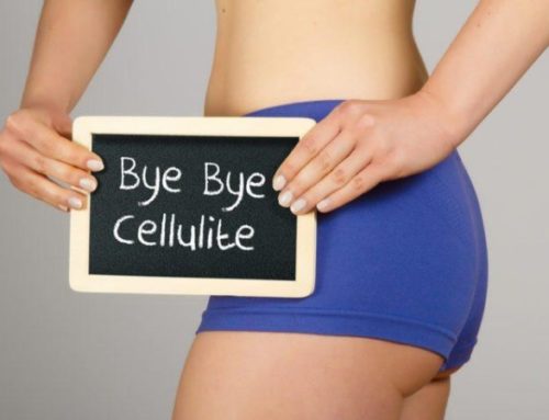 Cellulite Treatments: What are my Options?