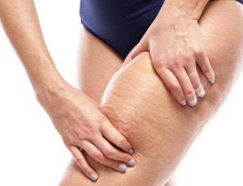 Cellulite Removal: What You Need to Know