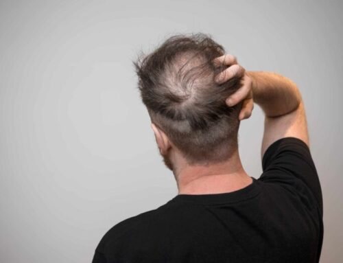 What Treatments Are Available For Hair Loss?